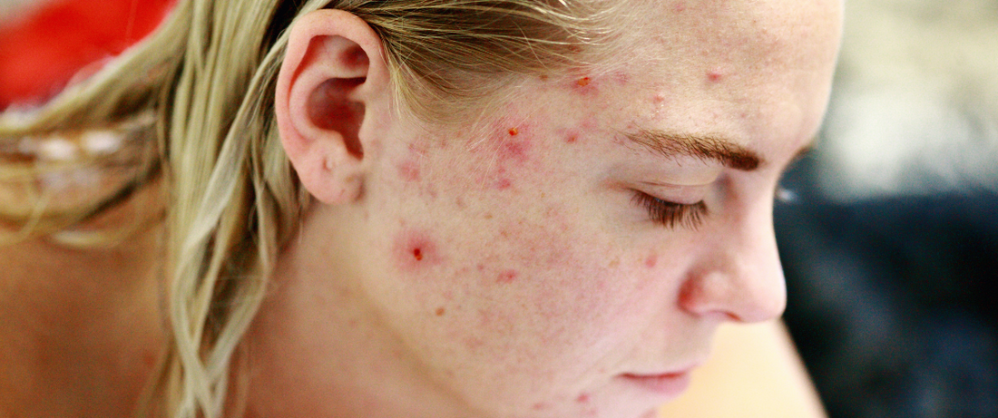 ACNE e CBD