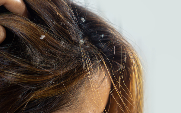 Forfora, prurito, capelli grassi? Abbiamo lo shampoo alla canapa che fa per te